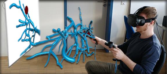 Das Lebergefäß ist mit einem Tumorposition versehen. In Virtual Reality kann dies nun genauer untersucht werden, um die Position des Tumors besser zu erkennen und die Situation des Patienten besser einschätzen zu können.