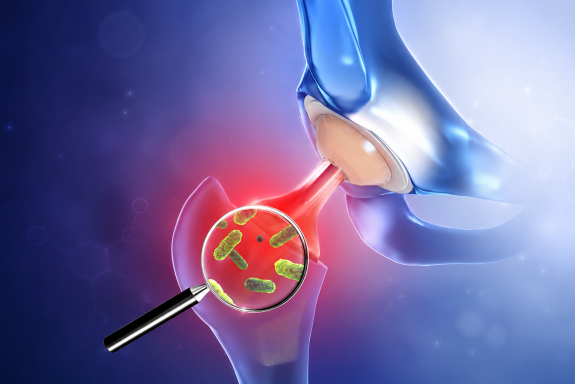 Antimikrobielle Biomaterialien: Innovative Strategien gegen Infektionen an Implantaten