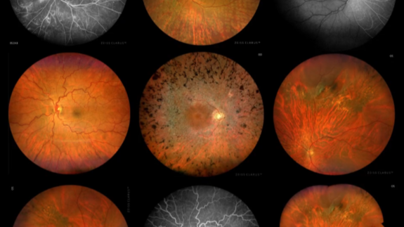 Collage aus neun farbigen und schwarz-weißen Netzhautaufnahmen mit verschiedenen Bildgebungsverfahren von ZEISS CLARUS.